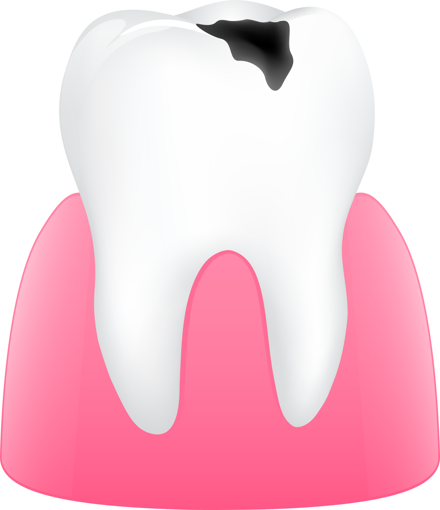 tooth caries