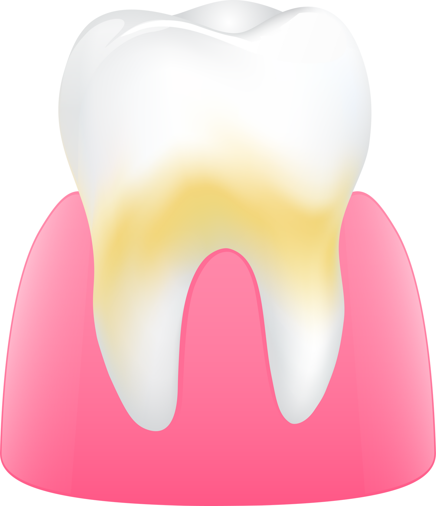 tooth with plaque