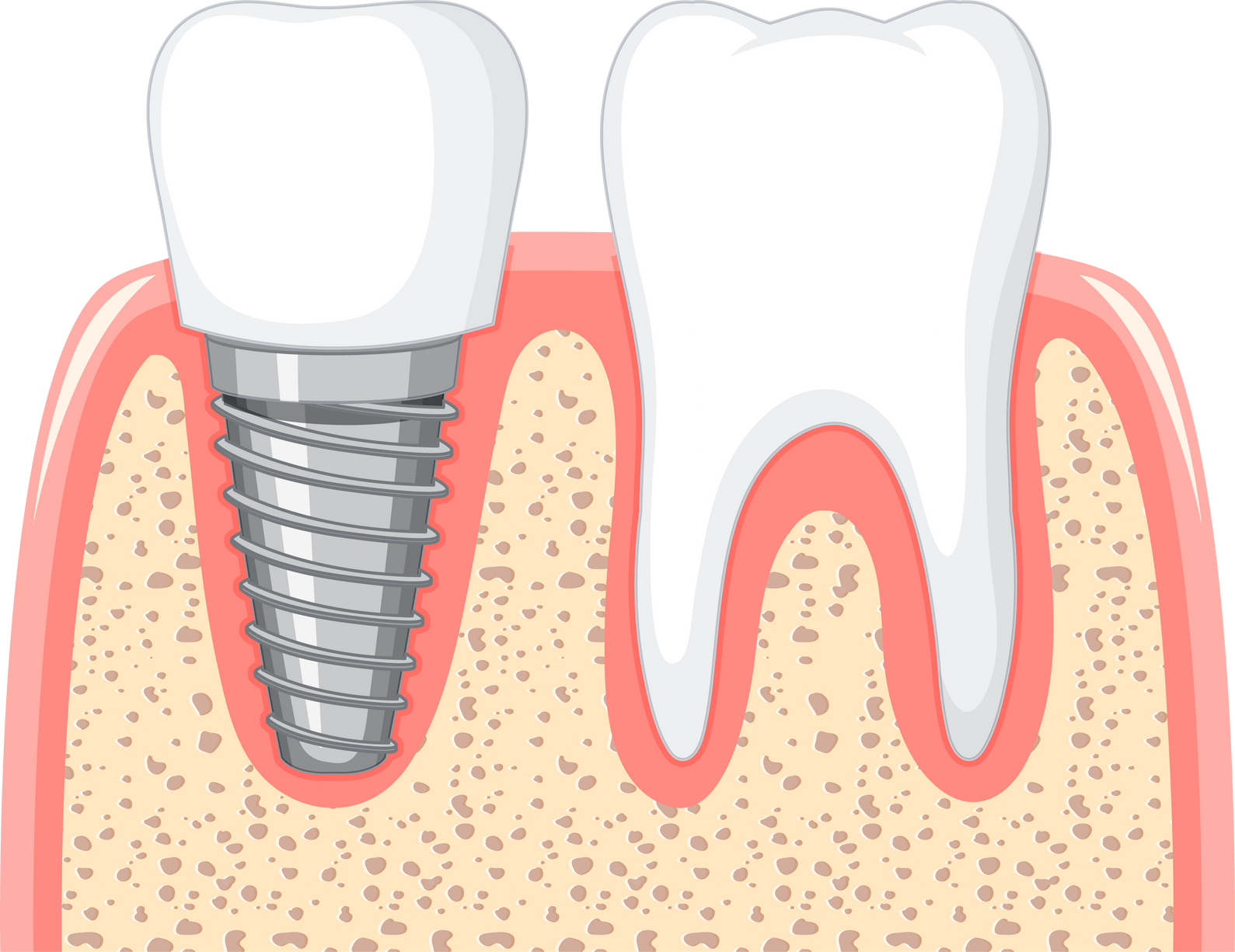 Heathy Tooth and Dental Implant in Gum on White Background